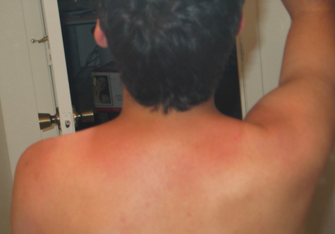 [picture: my back, burnt to a crisp in the shape of a tank top]